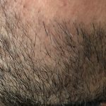 zagęszczanie brody i zarostu