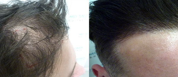 przed i po przeszczepie włosów