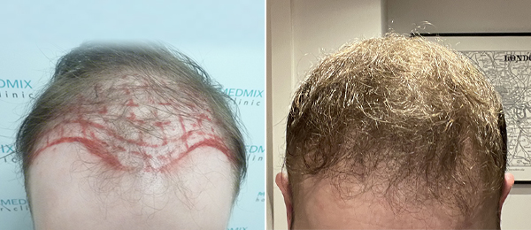 przed i po przeszczepie włosów